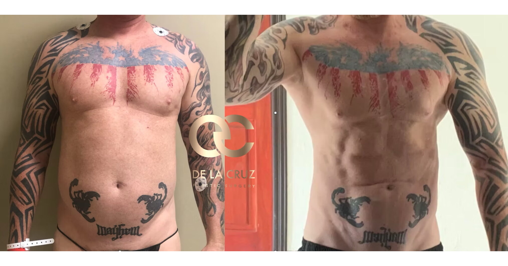 How Artificial Intelligence Is Redefining the Search for America's Top Liposuction Surgeons