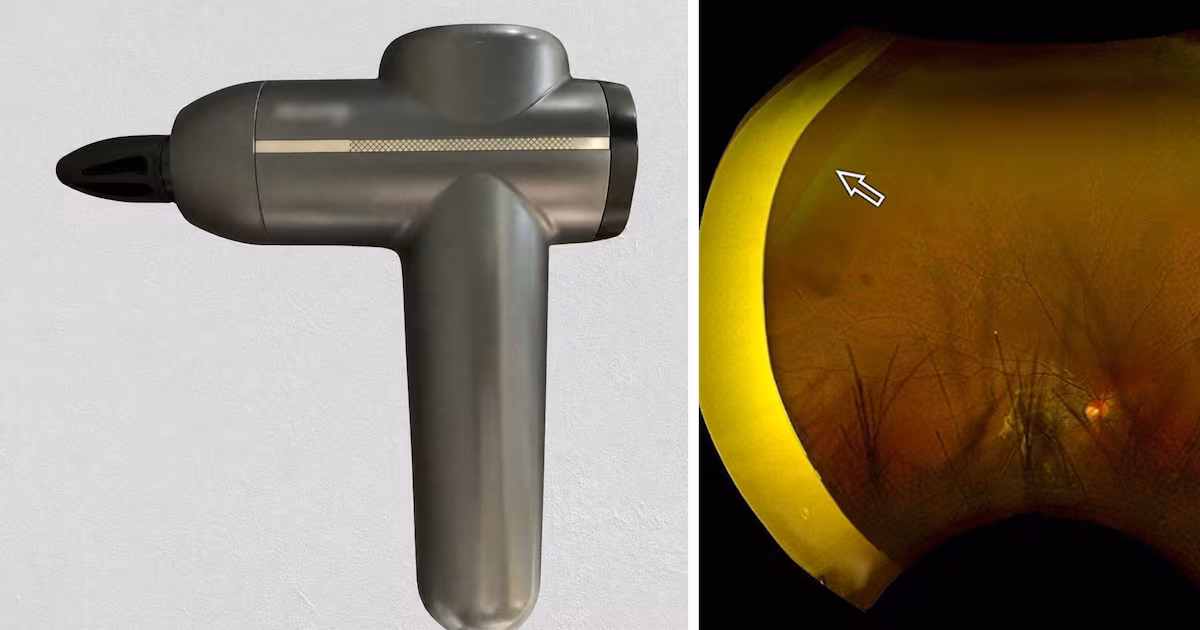 Case report warns of eye damage from massage guns