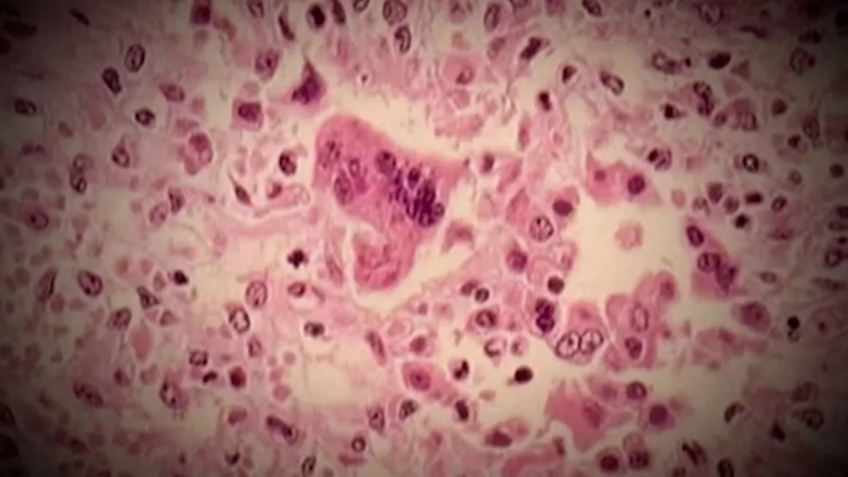 Measles outbreak in Portneuf, Que., grows to 7 cases