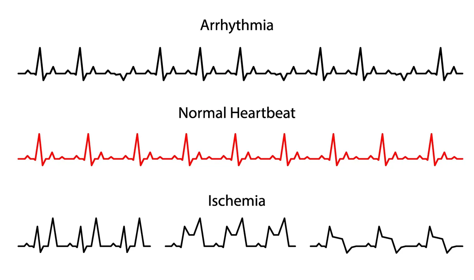 How Artificial Intelligence Discovered A New Way To Detect Patients At Risk Of Cardiac Death Using Simple EKGs