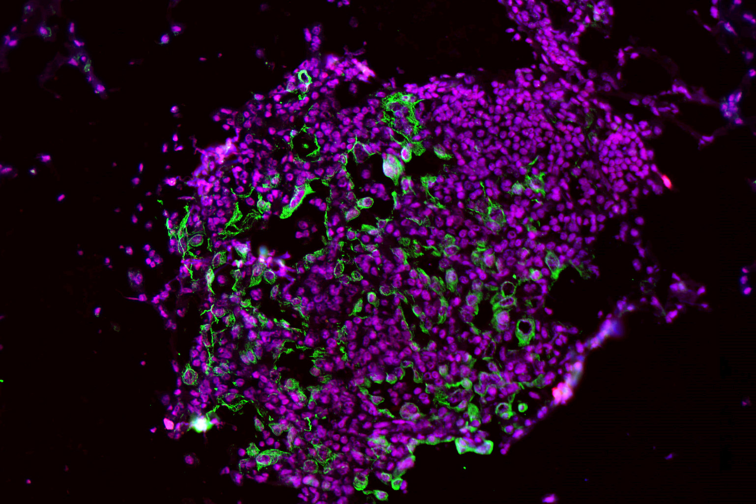 Drug that targets an inflammatory enzyme could help prevent lung cancer