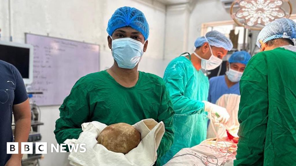 Doctors remove 3.1kg stone from man's bladder and claim record